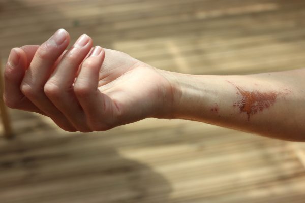 Narben Behandlung Laser Dortmund Narben Behandlung Laser Dortmund